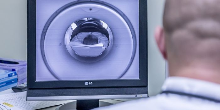Are High-Strength MRIs Releasing Mercury from Dental Fillings?