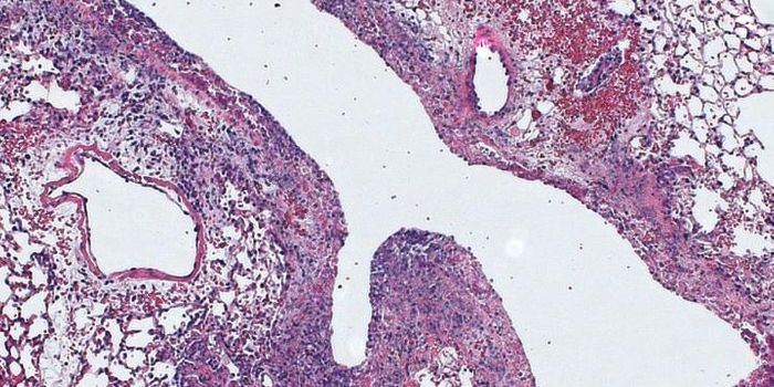 New Anti-Pneumonia Technique In The Face of Antibiotic Resistance