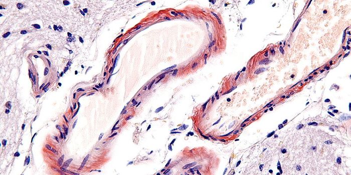 Is Biogen's Alzheimer's Drug, Aducanumab, a Panacea for Alzheimer's?