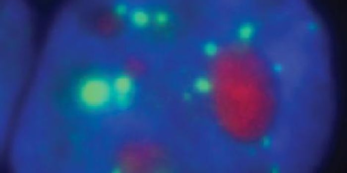 Some Cancer Cells Have Amyloids like Alzheimer's