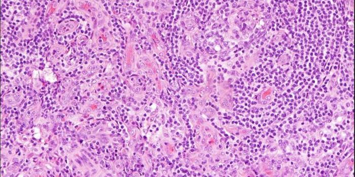 Diagnosing "Castleman Disease"