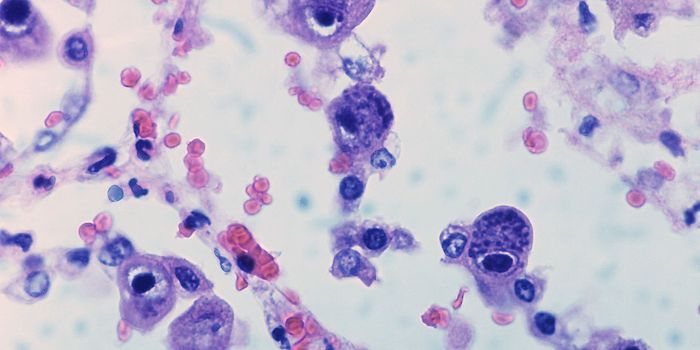 Congenital Herpes Infection Linked to Childhood Leukemia