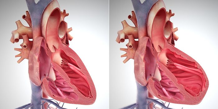 Heart Failure Death Rates Higher in Females than Males