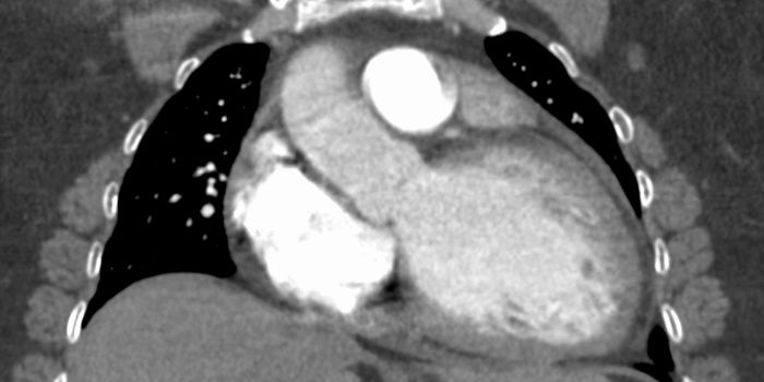 Immune Cells and Heart Disease: Helpful or Harmful?