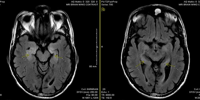 Autoimmune Encephalitis Mimics Effect of "Angel Dust"