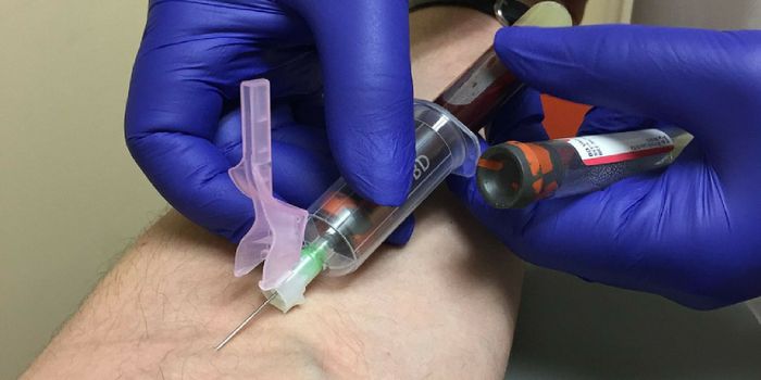 Blood 'Fingerprint' Reveals Alzheimer's Status