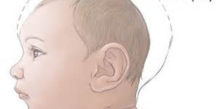 New Gene Defect Identified That Leads to Microcephaly and Dwarfism