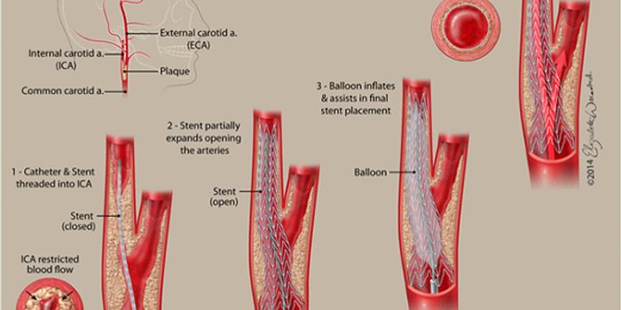 Air Pollution Linked with Narrowing of the Arteries