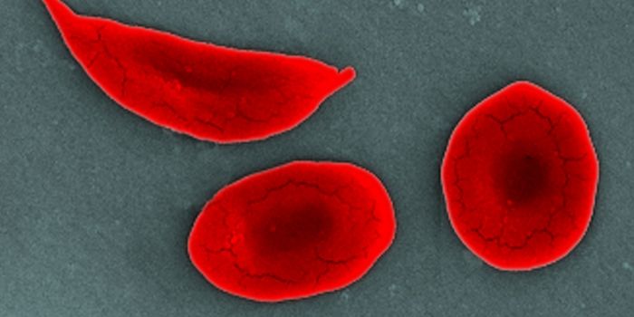 Antibiotics for Sickle Cell Disease?