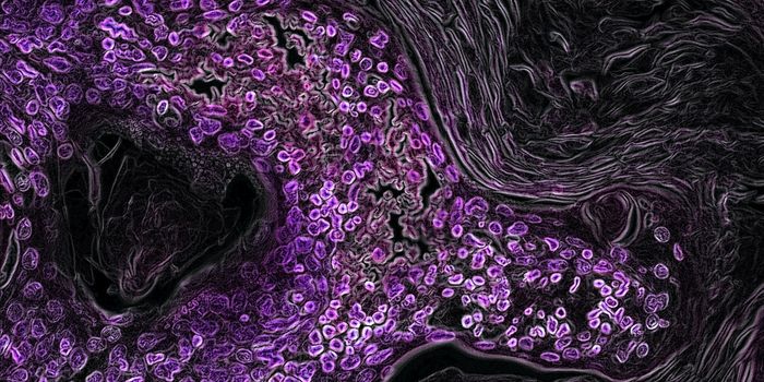 Liposomal Delivery Could Help Prevent Doxorubicin Cardiotoxicity