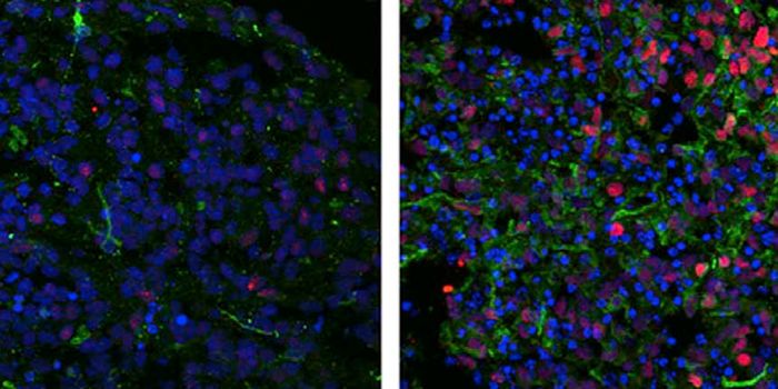 Autistic Brains Differ Biologically