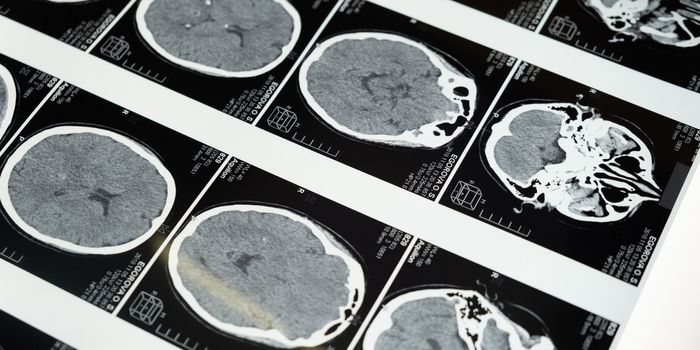 Immune Cells Help Brain Tumors Spread, but We Can Stop Them