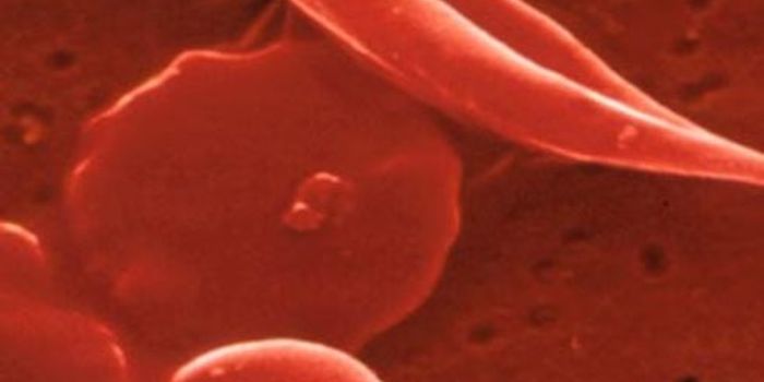 Crossing the ‘Valley of Death': Gene Therapy is on Its Way to Curing Sickle Cell Disease