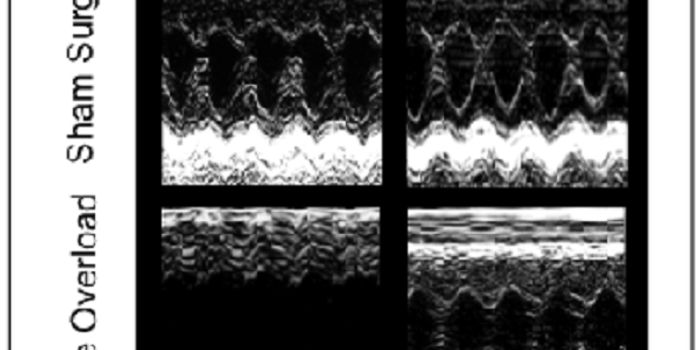 'Missing Culprit' in Heart Failure