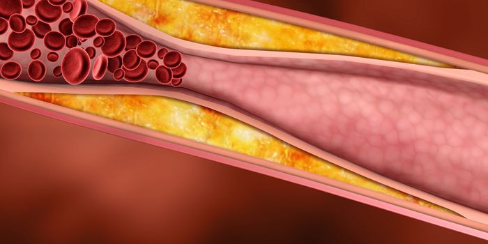 Rare Gene Deletion Prevents Atherosclerosis