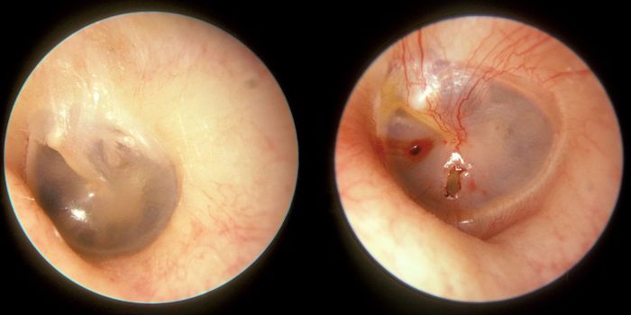 Enabling the Eardrum to Heal Itself