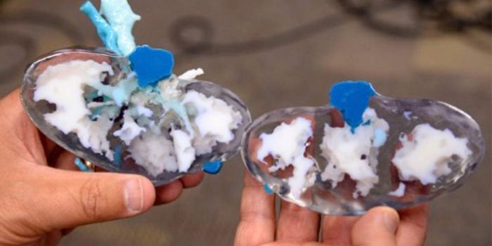 How 3D Printing Helped Surgeons Remove a Tumor