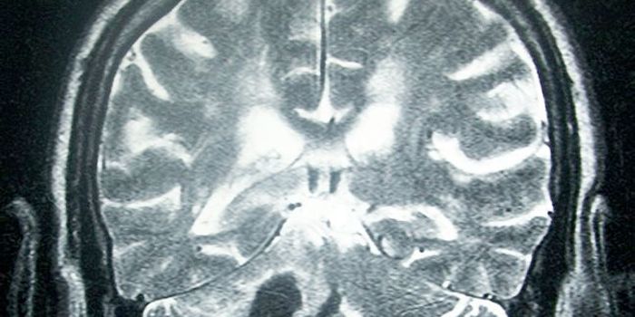 Inflammatory Cells Transformed Into 'Beneficial Weapons' To Heal Brain Damage