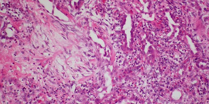 B Cells Control Connective Tissue Disorder Scleroderma