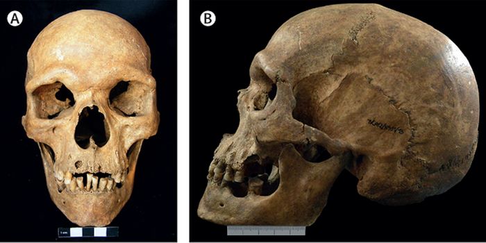 Rare Genetic Condition Discovered in Ancient Human