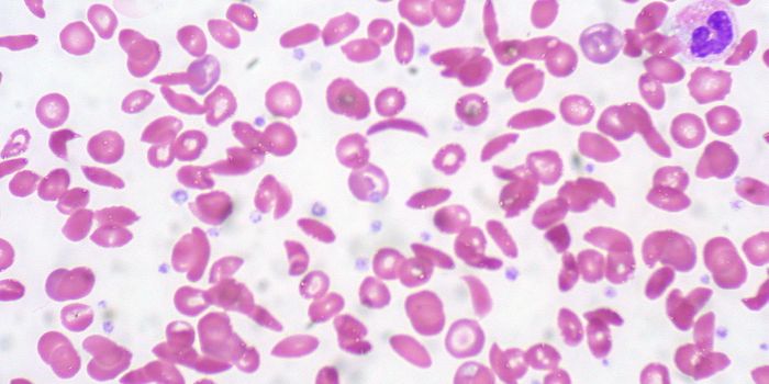 What's Causing Heart Complications in Sickle Cell Anemia Patients?