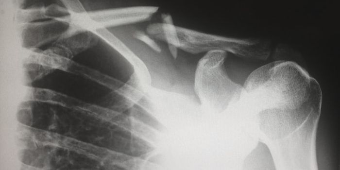 Drug Combo Targets Osteoarthritis