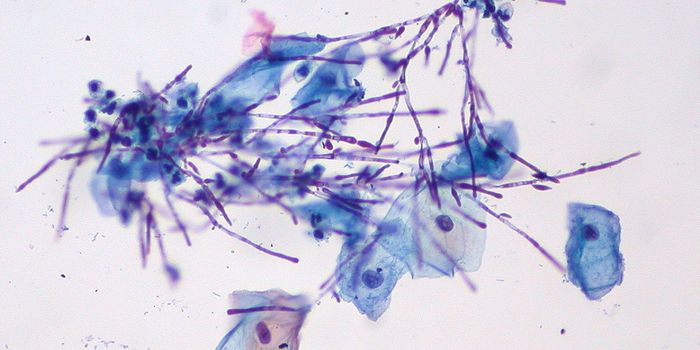 Yeast infection Symptoms Caused by Fungal Search for Zinc