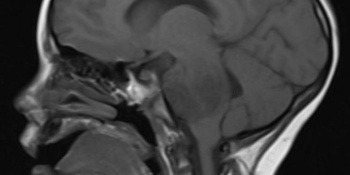 Strand of RNA Shuts Down Deadly Pediatric Cancer