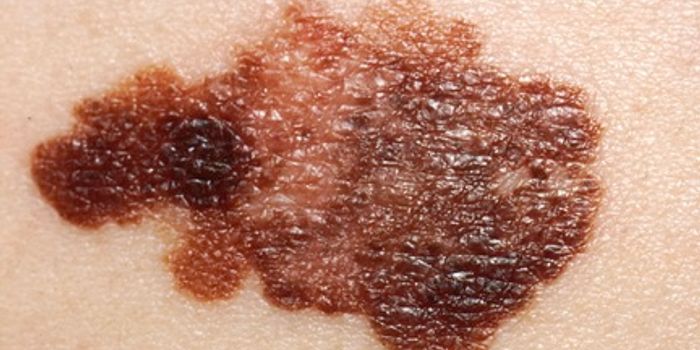 New Molecule Shrinks Melanoma Tumors and Prevents Relapse