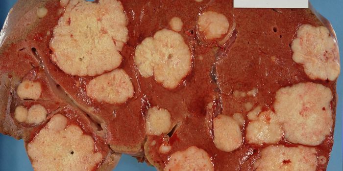 Micro RNA Panel Predicts Liver Cancer Risks