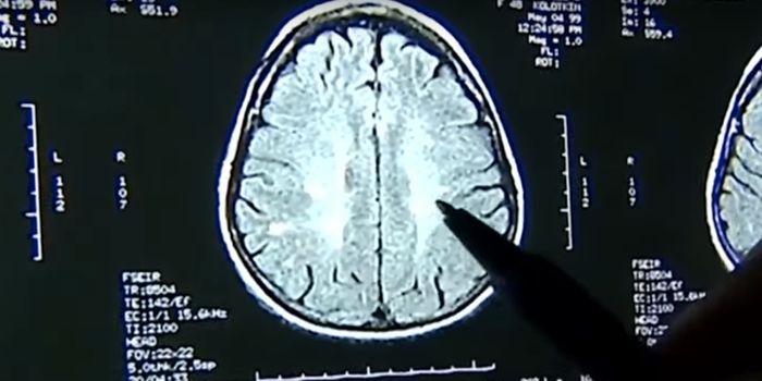 Testing Gene Therapy as a Potential Treatment for CTE