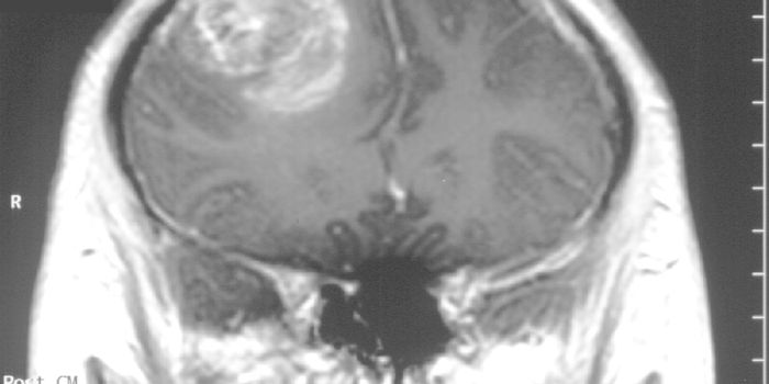 Glioblastoma Treatment Combines Vaccine and Chemo Technology