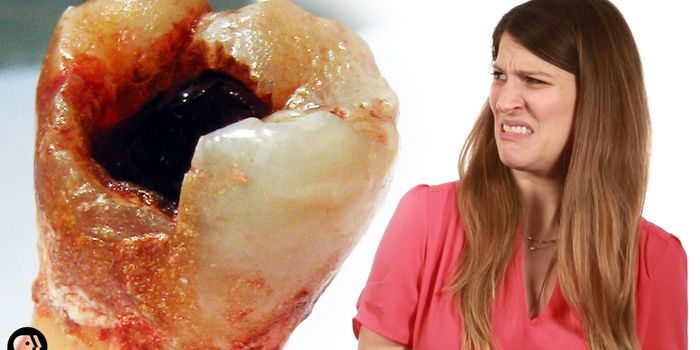 Here's the Science Behind Why You Get Cavities