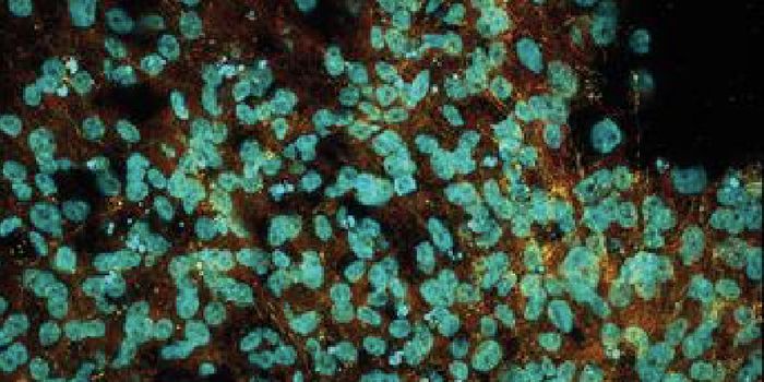 Organoids Reveal a New Player in Huntington's Disease