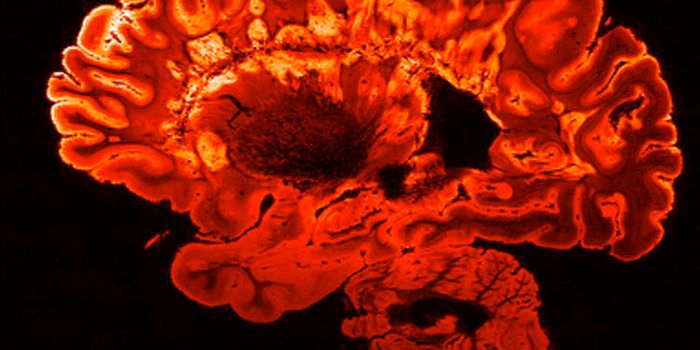 Protecting Gray Matter with MS Therapies: The Promise of Anti-CD20 and BAFF