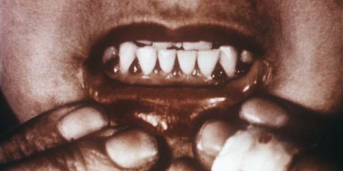 Diagnosed: Scurvy Makes a Comeback in Australia