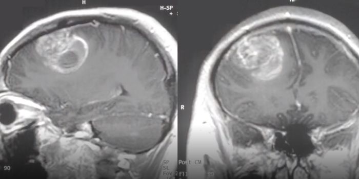 Glioblastoma Affects Men Differently Than Women