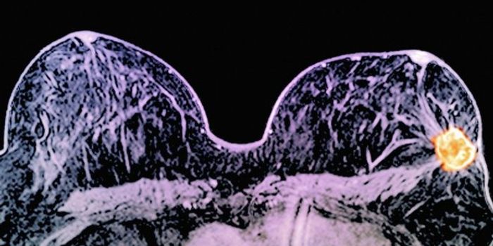 Drug Duo Dramatically Shrunk Breast Tumors in 11 Days