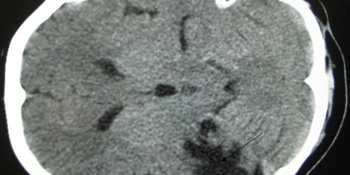 Class of Neuroprotective Molecules Discovered