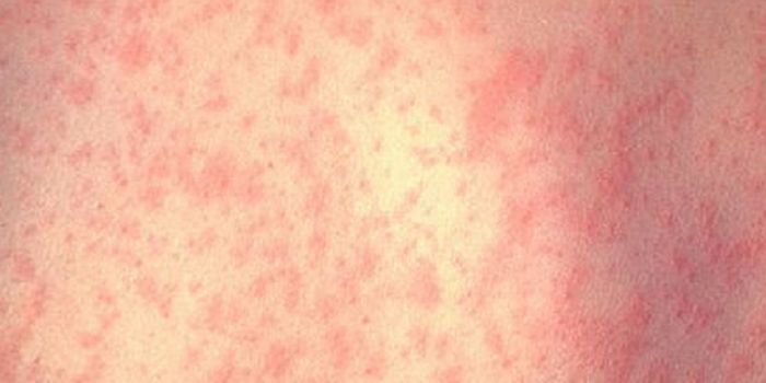 Measles are on the Move