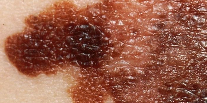 Study Reveals a Hidden Gene Target For Melanoma