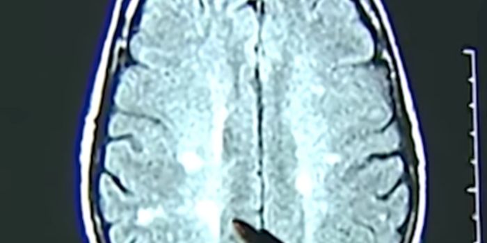 How Factors Combine to Amplify the Risk of MS