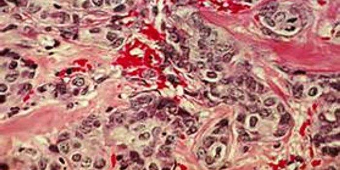 NSAIDs Stave Off Cancer Recurrence for Overweight Breast Cancer Patients, Study Finds