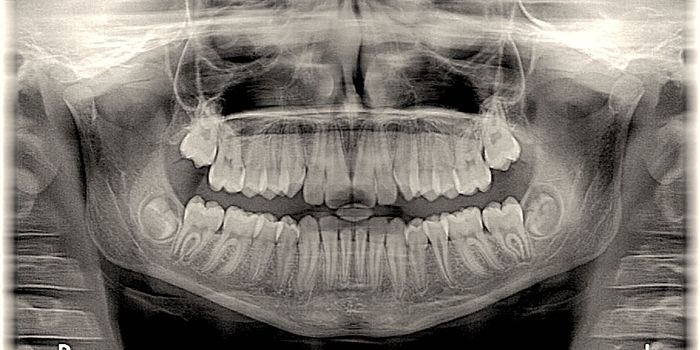 Scientists Regenerate Missing Teeth in Mice