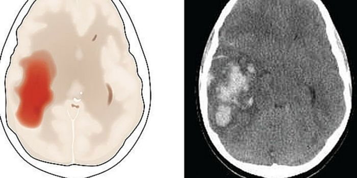 Taking Stroke Treatment On The Road