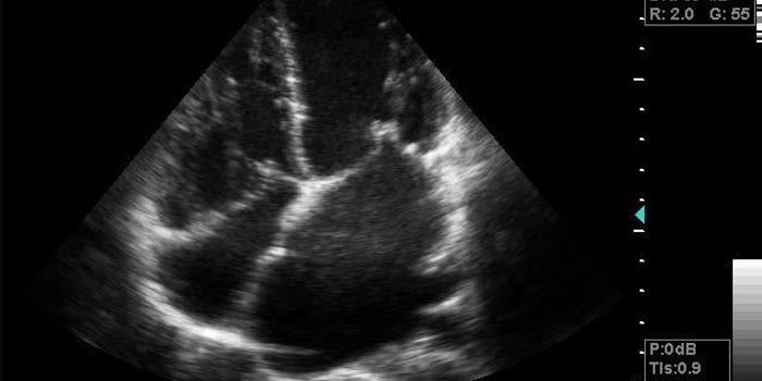 Improving Prevention Measures for Rheumatic Heart Disease