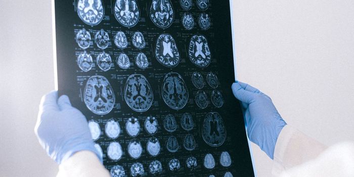 AI Predicts Recovery from Severe Brain Injury with 80% Accuracy