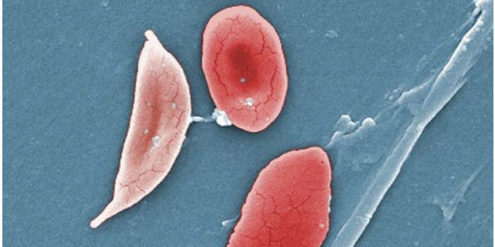 FDA Approves First Sickle Cell Drug in 2 Decades