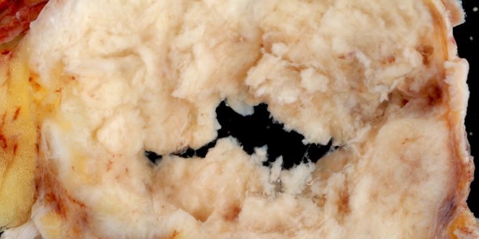 Double dose of this cancer treatment rejuvenates immune cells in Head and Neck Cancer