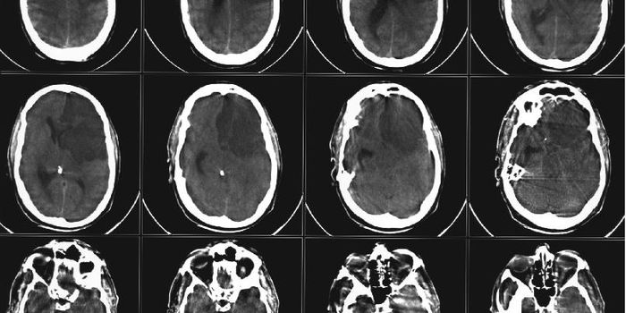 Decades of Research to Restore Blood Flow to the Brain